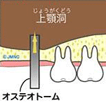 ソケットリフト図