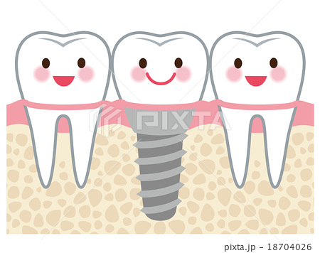 歯　インプラント　構造