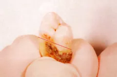 歯周病サンプル